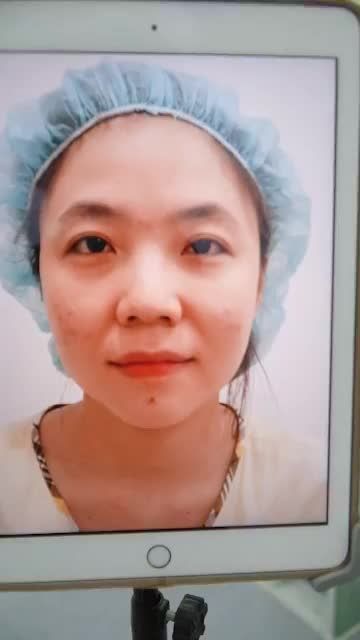 SAU PHẪU THUẬT: ĐÃ CÓ KẾT QUẢ NÂNG MŨI CẤU TRÚC SAU 45P