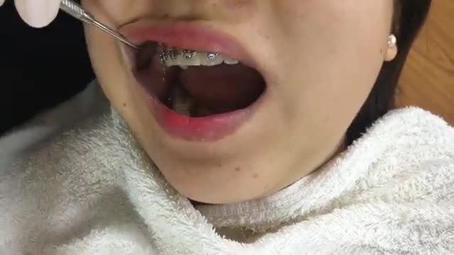 THÁO MẮC CÀI bung lụa cho một bạn nữ xinh đẹp sau niềng răng