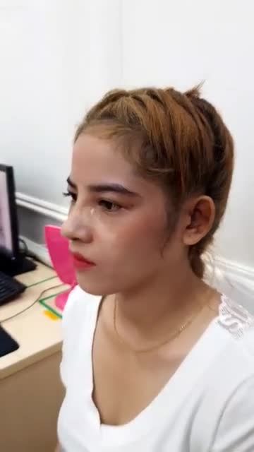 Cận cảnh khách hàng NÂNG MŨI CẤU TRÚC 4D chỉ sau 10 NGÀY