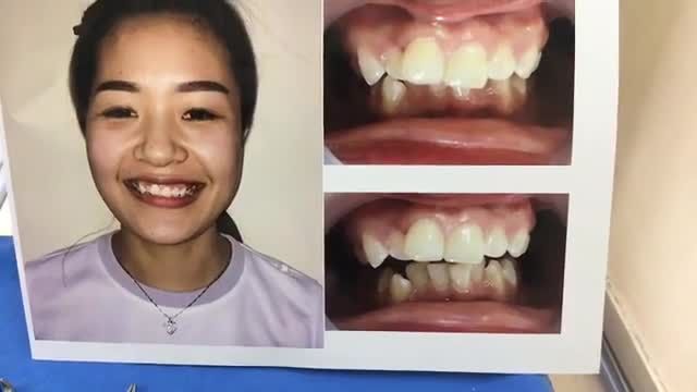 ca Tháo mắc cài cho bạn Lan