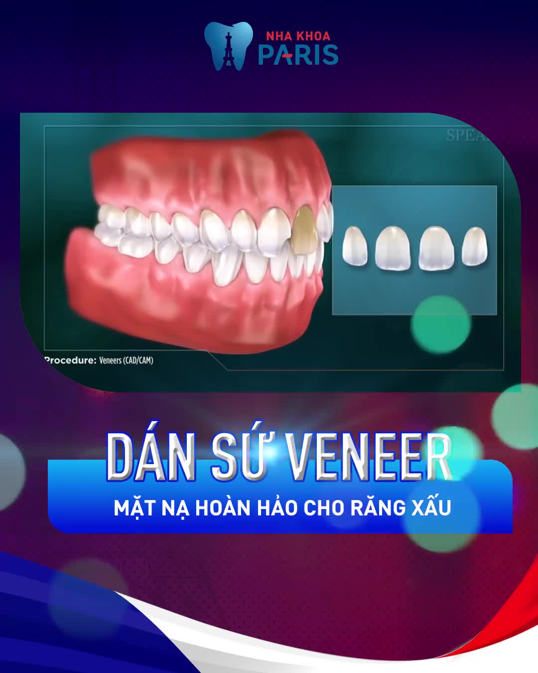 Mặt Dán Sứ Veneer Không Mài răng
