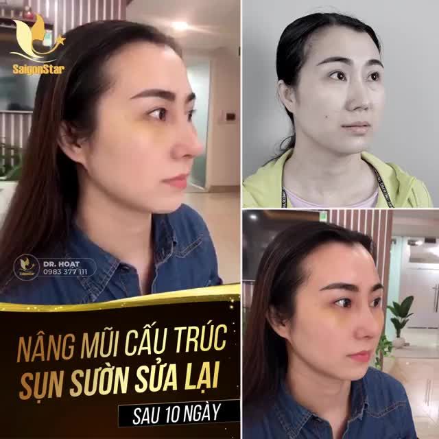 NÂNG MŨI CẤU TRÚC SỤN SƯỜN SỬA LẠI SAU 10 NGÀY