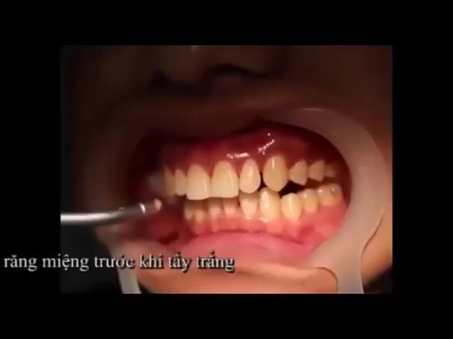 TẨY TRẮNG RĂNG CÔNG NGHỆ CAO TRẮNG GẤP 3 SO VỚI CÔNG NGHỆ CŨ