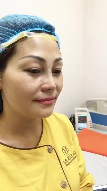 Cùng xem kết quả nâng mũi Demi 5D kết hợp thu cánh mũi cho vị khách hàng một chiếc mũi cao tây và tự nhiên