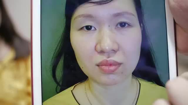 Cùng theo dõi kết quả sự thay đổi nhan sắc sau khi cắt mí Mani Open Deep 5D kết hợp chuyển mỡ mí mắt tại Dr. Hải Lê