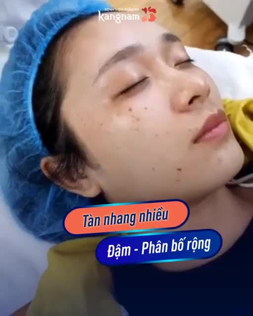 LOẠI BỎ TÀN NHANG - Lấy lại tuổi trẻ với Laser Picosure