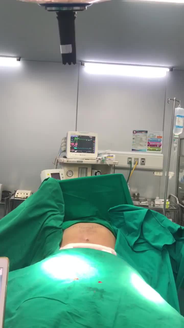 case hút mỡ tạo hình thành bụng cho chị khách hàng 43T với vòng bụng siêu to, vòng eo hơn 100cm