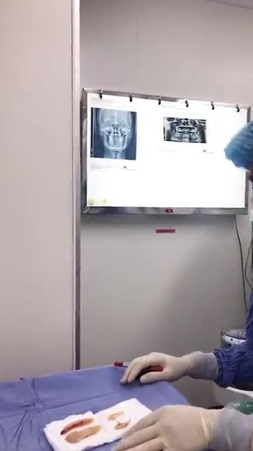 Cùng nghe bác sĩ phân tích về Hạ gò má, gọt hàm VLINE cho khách hàng tại BVTM ĐÔNG Á