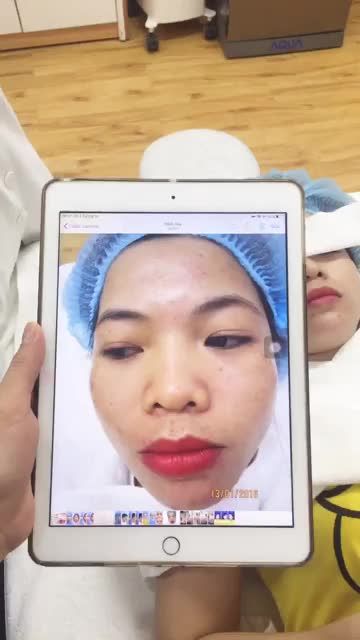 Khách hàng sử dụng dịch vụ điều trị nám bằng Công nghệ Melas reno tại Bệnh viện thẩm mỹ Đông Á