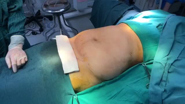 Đồng hành cùng Dr. Vũ Quang thực hiện ca COMBO tạo hình bụng kết hợp hút mỡ cấy vòng 3
