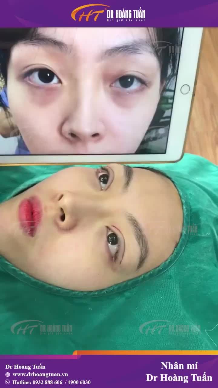Máy quay tia lia lịa để lấy hình ảnh bạn gái vừa nhấn mí tại Dr Hoàng Tuấn cho các chị em cùng ngắm nghía đây ạ