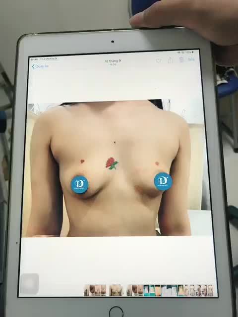 KẾT QUẢ COMBO NÂNG NGỰC + THTB của 1 chị KH rất là xinh đẹp, trẻ trung sau 14 ngày đến tái khám.