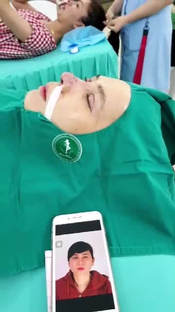 Nâng mũi Sform cuộn cánh bấm mí