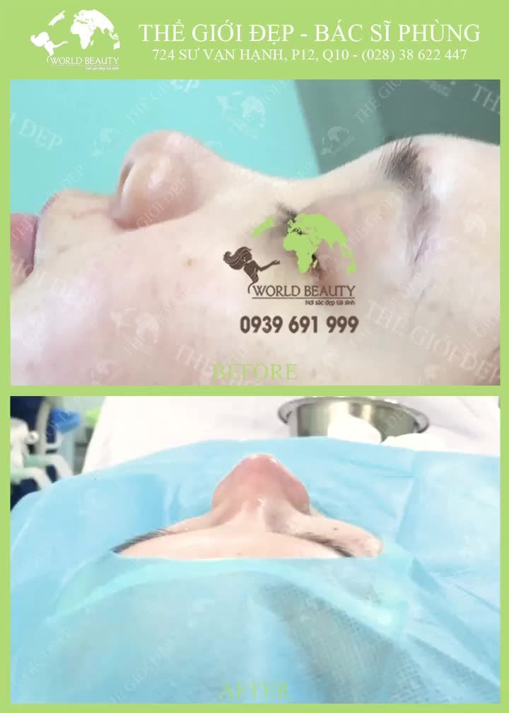 MŨI NGẮN, HẾCH, TO BÈ làm Bạn mất tự tin vì kém xinh?