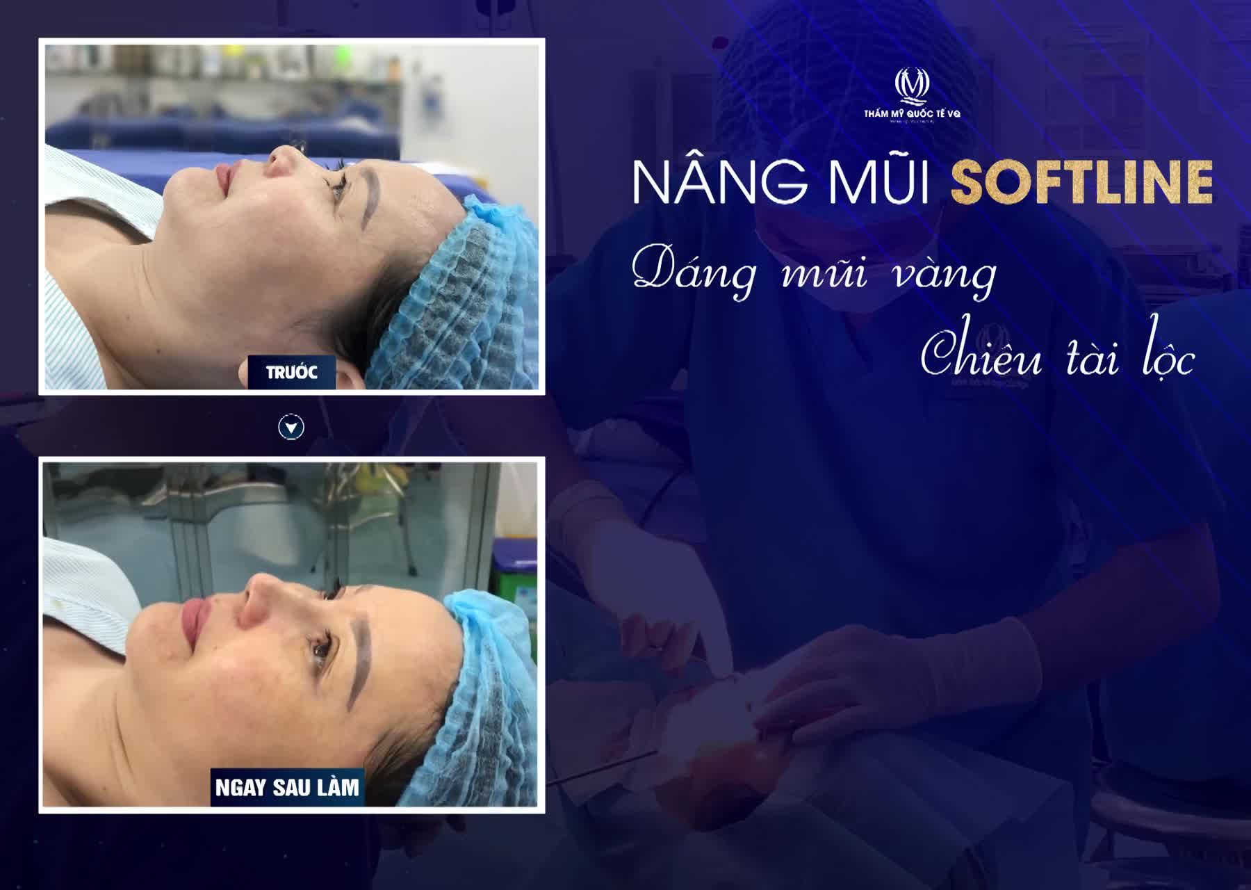QUÁ TRÌNH NÂNG MŨI SOFTLINE SAU 5 NGÀY