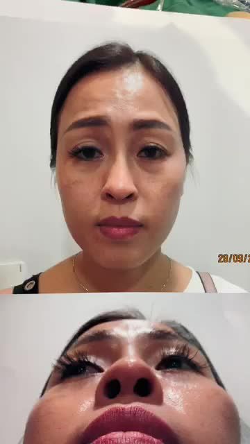 TÁI PHẪU THUẬT SIÊU DÁNG MŨI S LINE CHO TRƯỜNG HỢP MŨI LỘ SÓNG