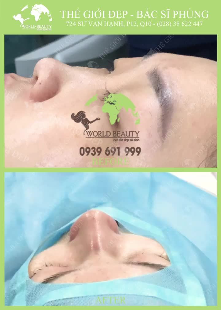 TRƯỚC và SAU phẫu thuật, MŨI khác nhau như thế nào?