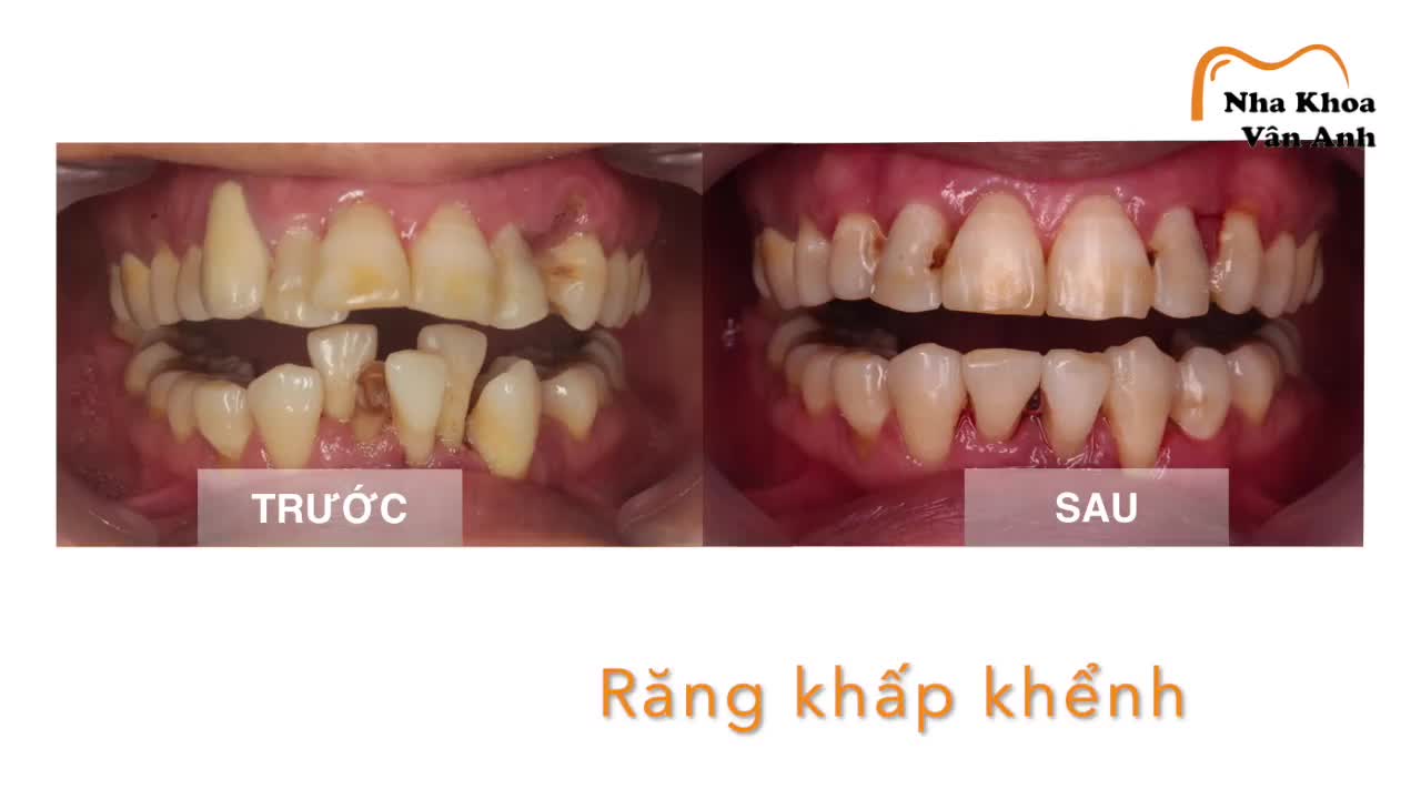 Cùng một người, nhưng nụ cười đã khác