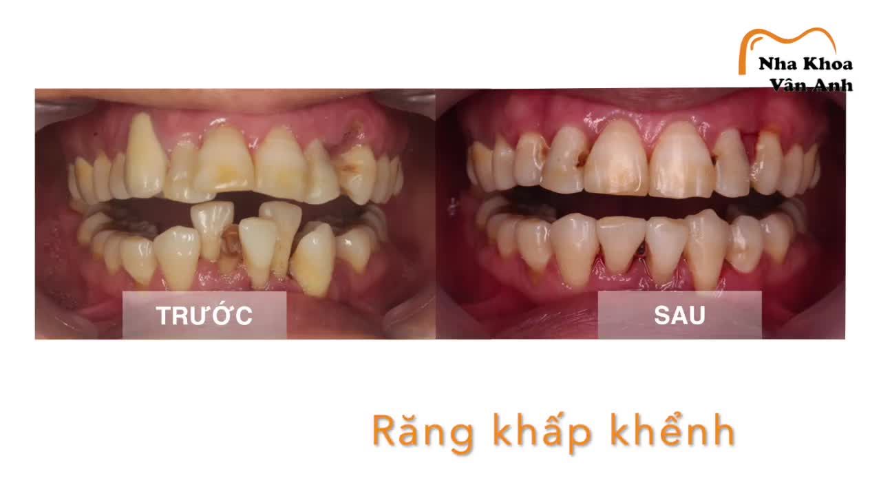 Cùng một người, nhưng nụ cười đã khác