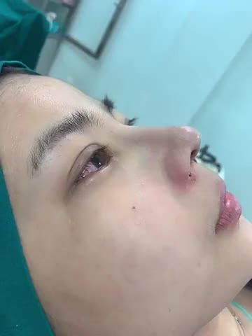 Mũi cấu trúc dáng Latin, xử lý khuyết điểm đầu mũi to, xương nền mũi rộng, cánh mũi bè cho KH vừa xong