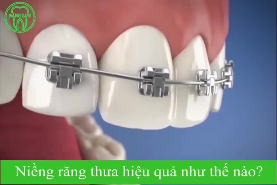 NIỀNG RĂNG THƯA CÓ HIỆU QUẢ KHÔNG