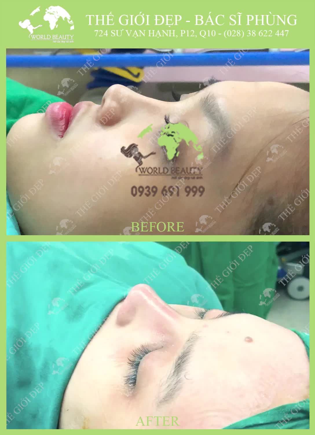 Sửa mũi Gồ Ngắn Hếch bẩm sinh diện mạo thay đổi như thế nào