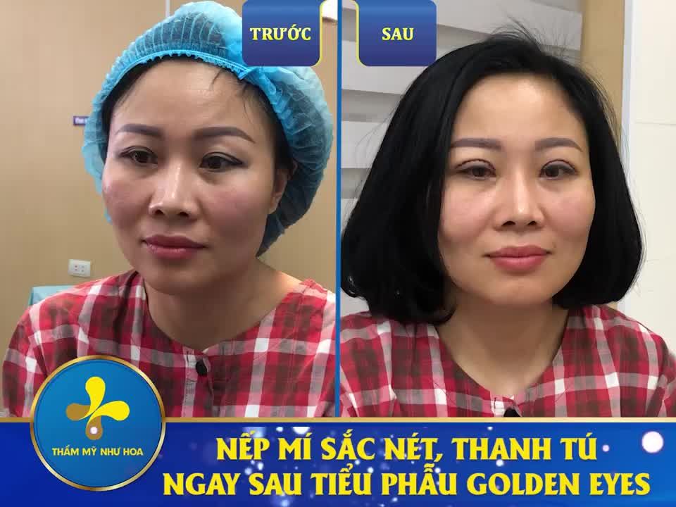 CHỈ 30 PHÚT SỞ HỮU ĐÔI MẮT 2 MÍ TO TRÒN, CUỐN HÚT