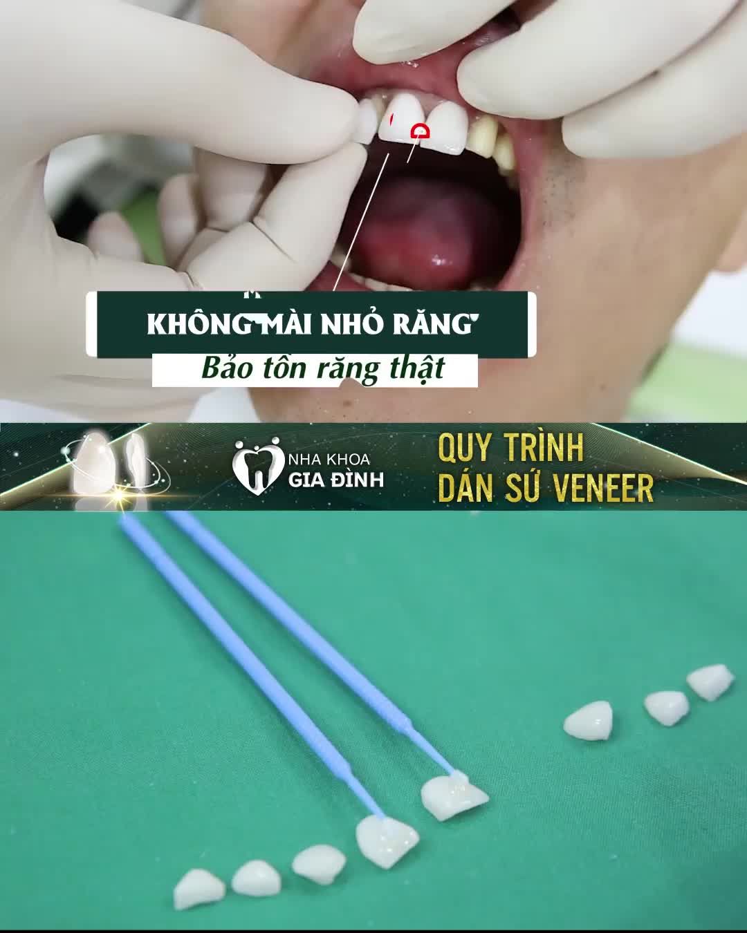 PHỦ SỨ VENEER - BẢO TỒN RĂNG GỐC - GIỮ NGUYÊN RĂNG THẬT