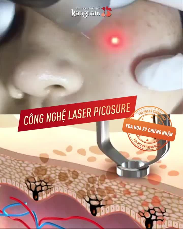 Chỉ từ 7TR - Da vắng bóng TÀN NHANG sau 1 lần điều trị