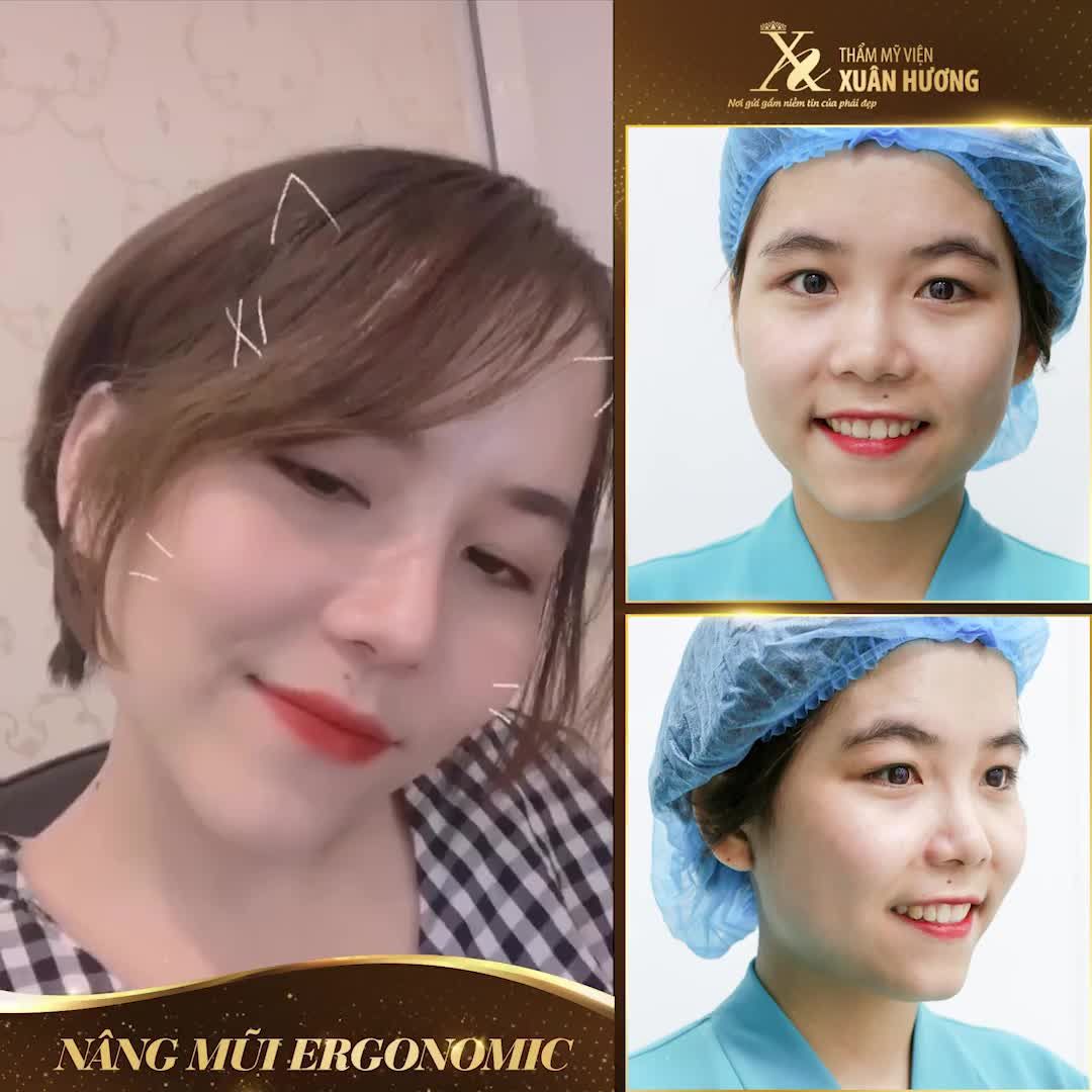 CÔ NÀNG HOÀI THƯƠNG "LỘT XÁC" NGOẠN MỤC CHỈ SAU 2,5 THÁNG NÂNG MŨI ERGONOMIC