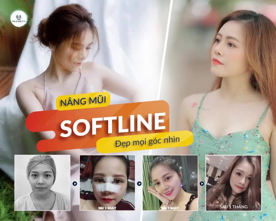 LOẠI BỎ TỰ TI MŨI THẤP TẸT VỚI NÂNG MŨI SOFTLINE TẠI THẨM MỸ QUỐC TẾ VQ
