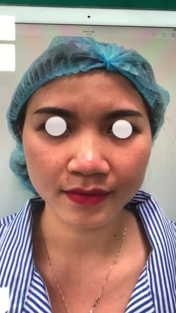 NÂNG MŨI BỌC SỤN ĐẸP TỰ NHIÊN, KHÔNG BIẾN CHỨNG