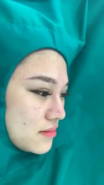 SỬA MŨI NÂNG SPA BỊ NHIỄM TRÙNG CỦA KH TẠI DR.HOAN