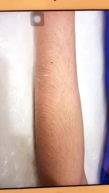 Triệt lông tay công nghệ Diot Laser không đau tại Thẩm mỹ viện Đông Á