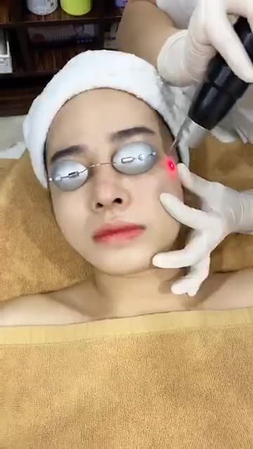 Chẳng ngại BỚT BẨM SINH với điều trị bớt bằng Laser Picosure tại Kangnam
