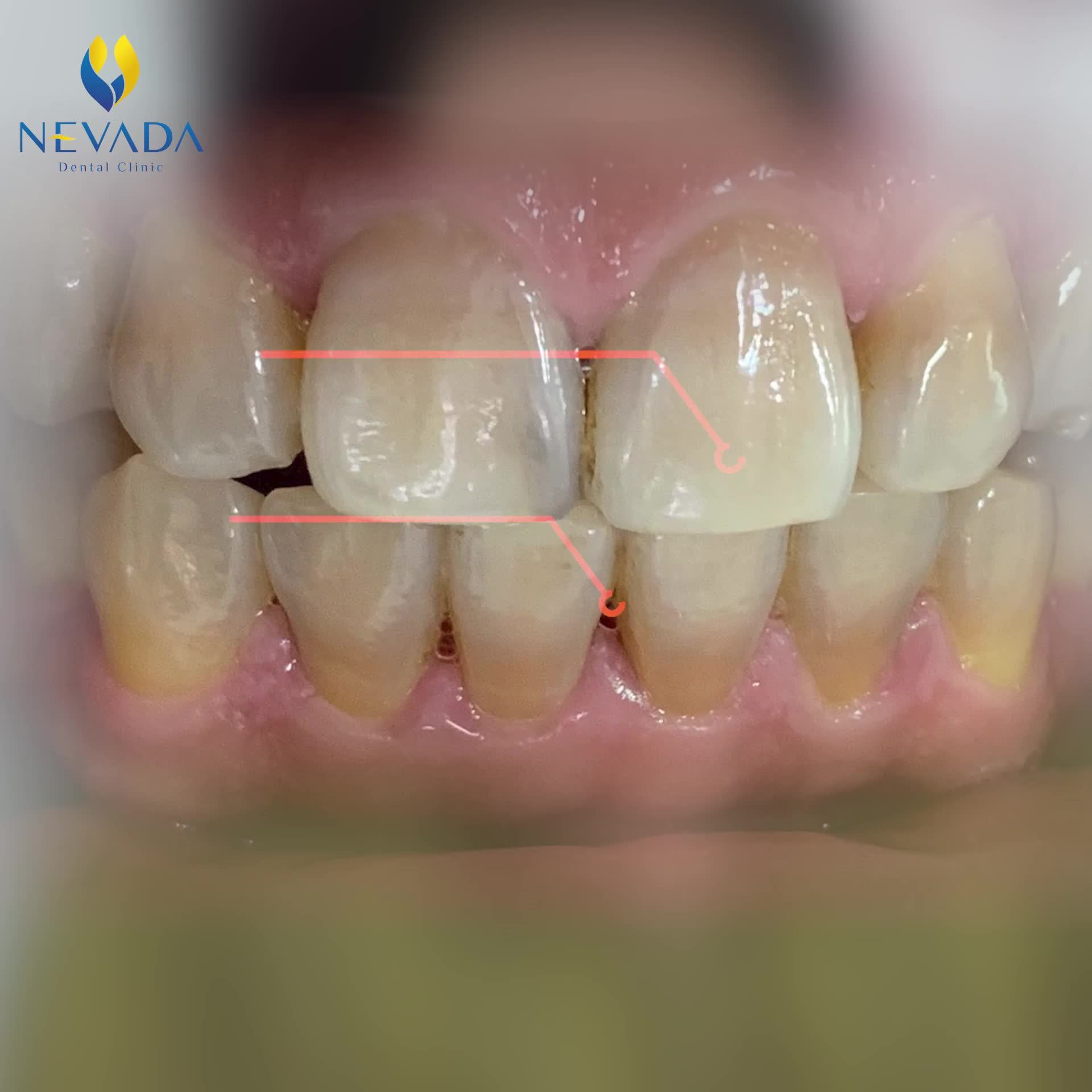 HÀNH TRÌNH LỘT XÁC NỤ CƯỜI VỚI 16 RĂNG SỨ