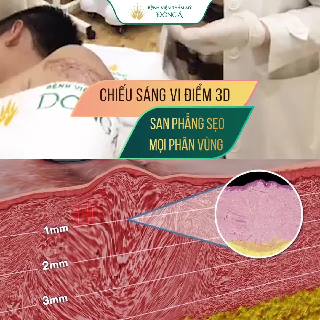 Đến Đông Á: San phẳng 100% sẹo lồi mọi cấp độ: Diện tích lớn, tăng sinh, ngứa