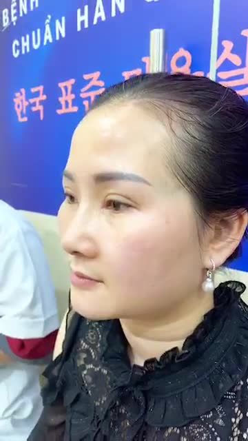 “Lột xác hoàn toàn” sau nâng mũi và cắt mí tại BVTM Kangnam