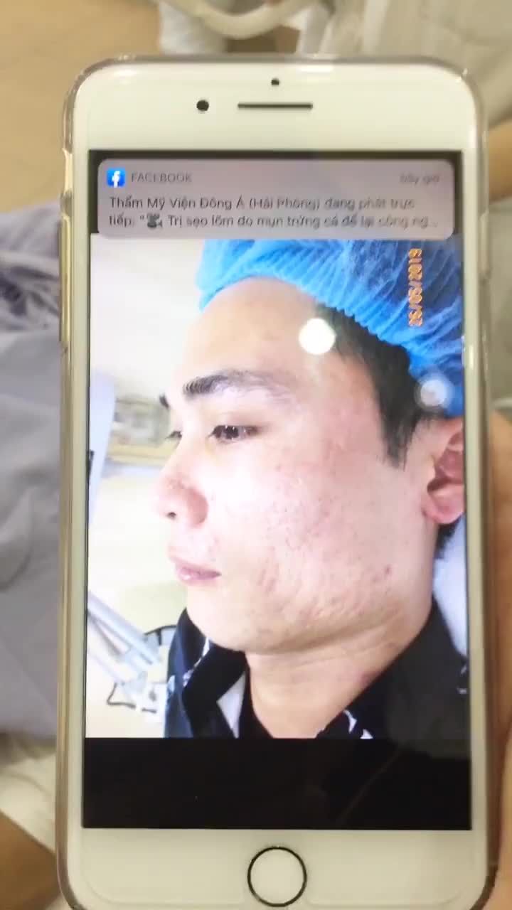 Cận cảnh tách đáy sẹo lõm cho khách hàng nam tại Đông Á Hải Phòng.