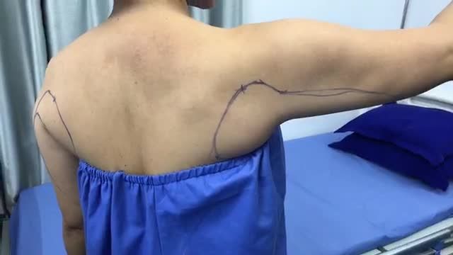 Ca hút mỡ bắp tay chiều muộn của bác sĩ