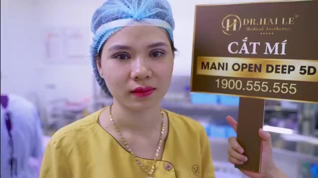 Cùng theo dõi kết quả của vị khách hàng sau khi cắt mí Mani Open Deep 5D tại Dr. Hải Lê