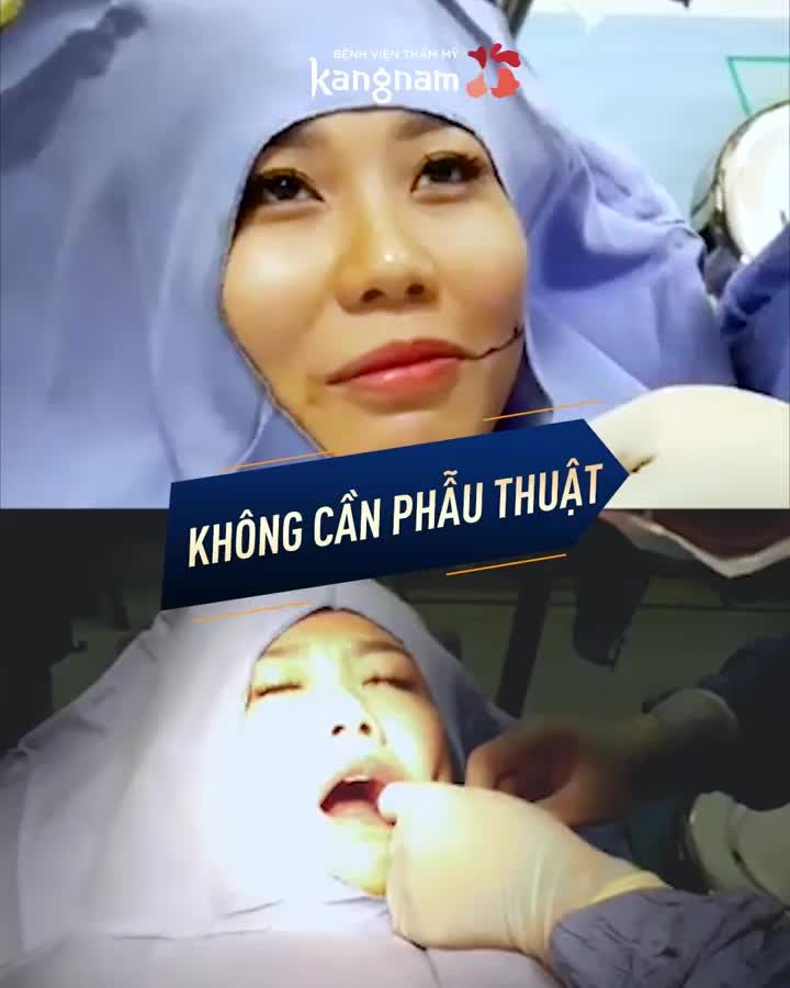 Tạo má lúm không cần phẫu thuật