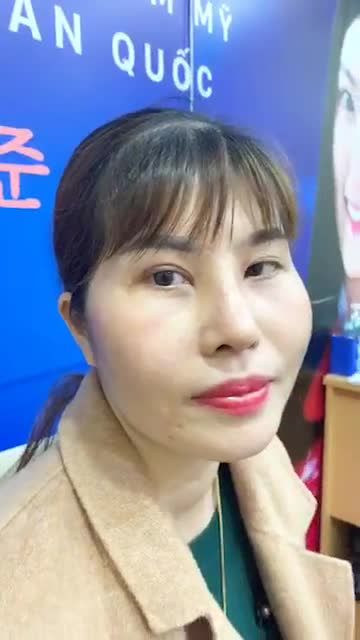 Khách hàng tái khám sau 10 ngày nâng mũi cấu trúc 4D tại BVTM Kangnam