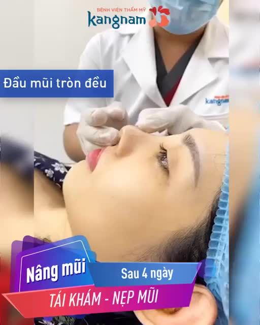 NÂNG MŨI đẹp thôi chưa đủ - Cần NẸP MŨI đúng cách!