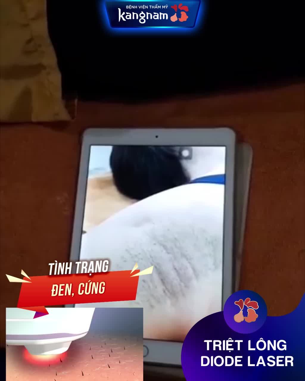 Lông nách làm nàng MẤT TỰ TIN? Đã có Diode Laser