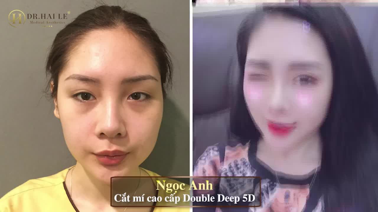 HOÀN HẢO TỚI TỪNG CHI TIẾT: CẮT MÍ CAO CẤP DOUBLE DEEP 5D