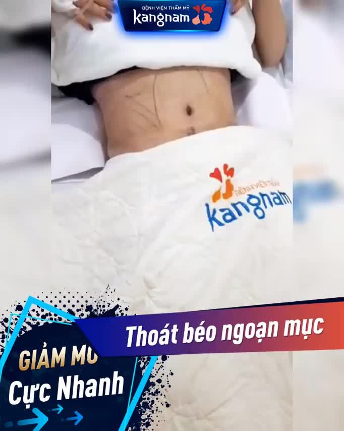 Giảm mỡ triệt để  Loại bỏ da chùng Thu gọn vòng 2 tối đa