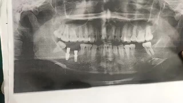 cắm implant cho bạn Duyên tại Nhà Khoa Thuỳ Anh.