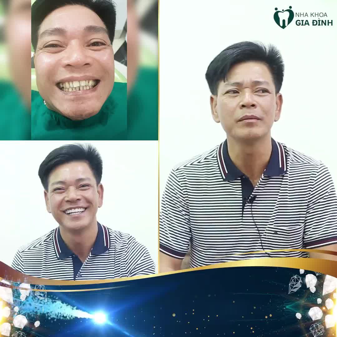 Cùng nghe anh Trong chia sẻ cảm nhận sau khi thẩm mỹ răng trong video dưới đây nhé!