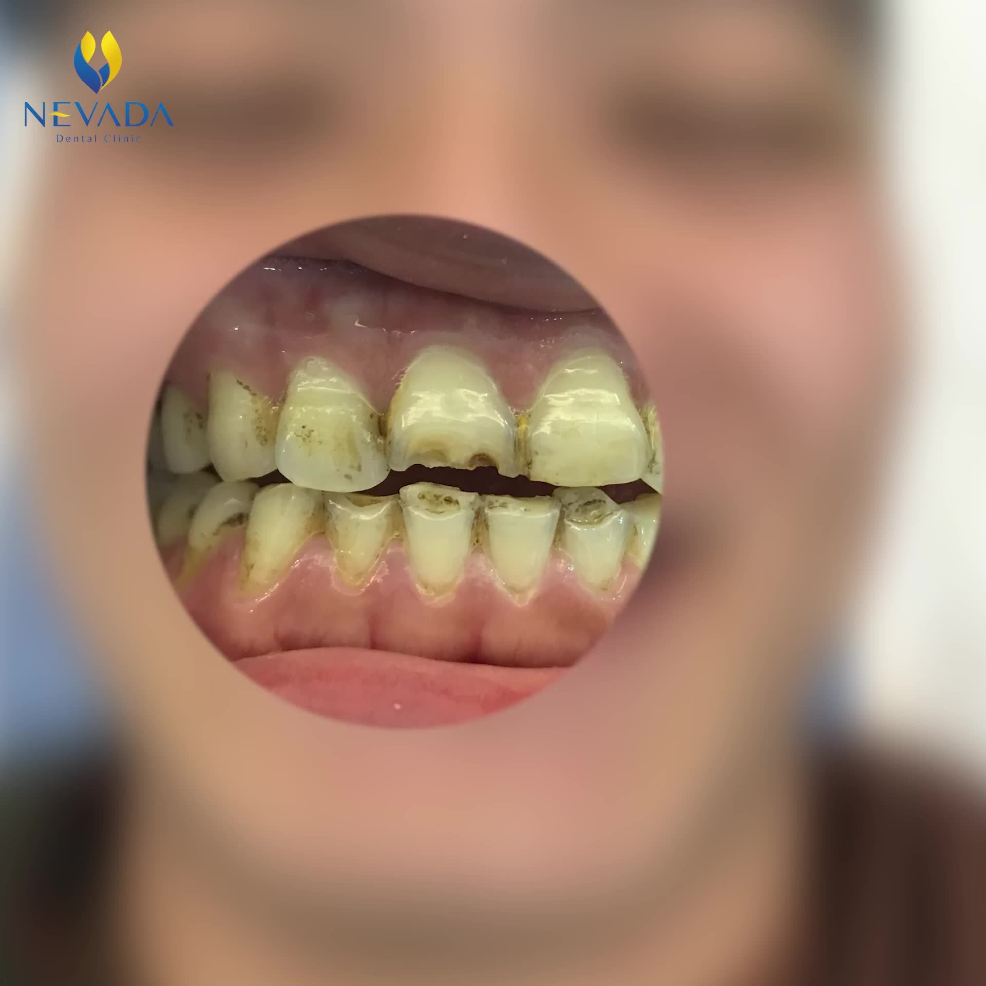 HÀNH TRÌNH LỘT XÁC VỚI 19 RĂNG SỨ